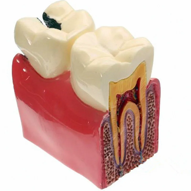 1 pc Dental Materials Lab Teeth Model 6 Times Caries Comparation Study Models For Dentist Studying and Researching