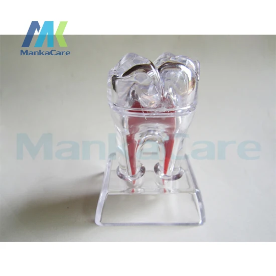 3 pcs Oral Model 4 Times Dental Implant Disease Teeth Model with Restoration Bridge Tooth Model Dentist for Medical Teaching