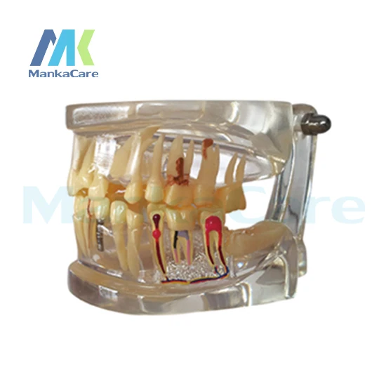 

Manka Care - Half Pathology Model Oral Model Teeth Tooth Model