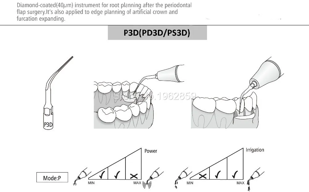 5pcs PD3D Dental Ultrasonic Scaler Tip Scaling Endo Perio Dentists Tools Periodontics Endodontics for SATELEC NSK GNATUS DTE