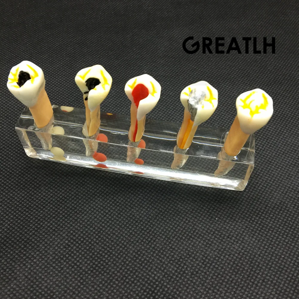 Dental 5 Stage Endodontic Treatment Model Dental Study Teach Teeth Model