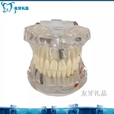 Adult teeth model transparent pathological planting model free shopping