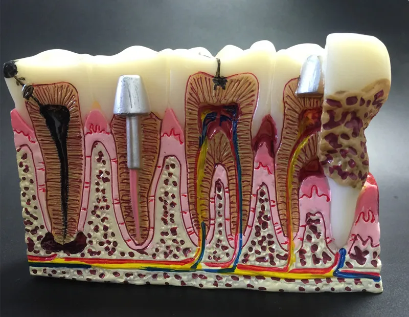 

Dental teeth common pathologies model teaching model ,Tooth Dentist for Medical Science Teaching