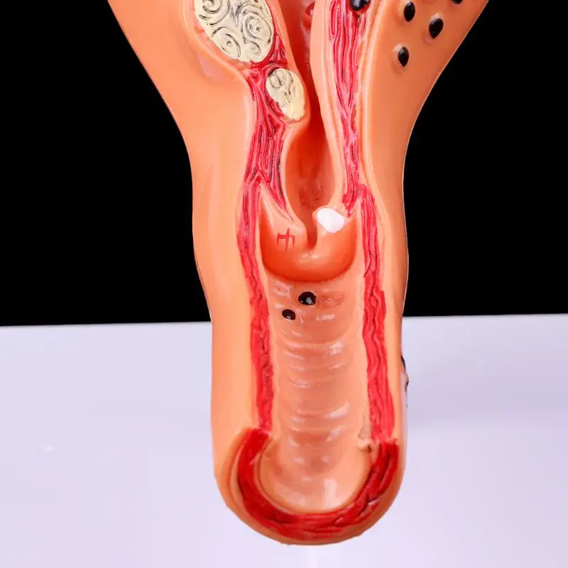 Medical props model Free postage Pathological Uterus Ovary Anatomical Model Anatomy Cross Section Study Tool