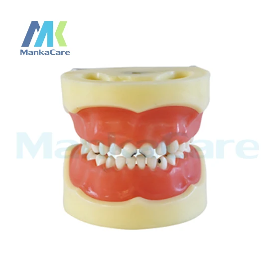 

Manka Care - Caries model of child/Gum can be removed Oral Model Teeth Tooth Model