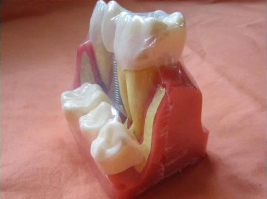 free shipping Dental teeth model dental planting teeth model decomposition tooth model exploded removable dental teaching model