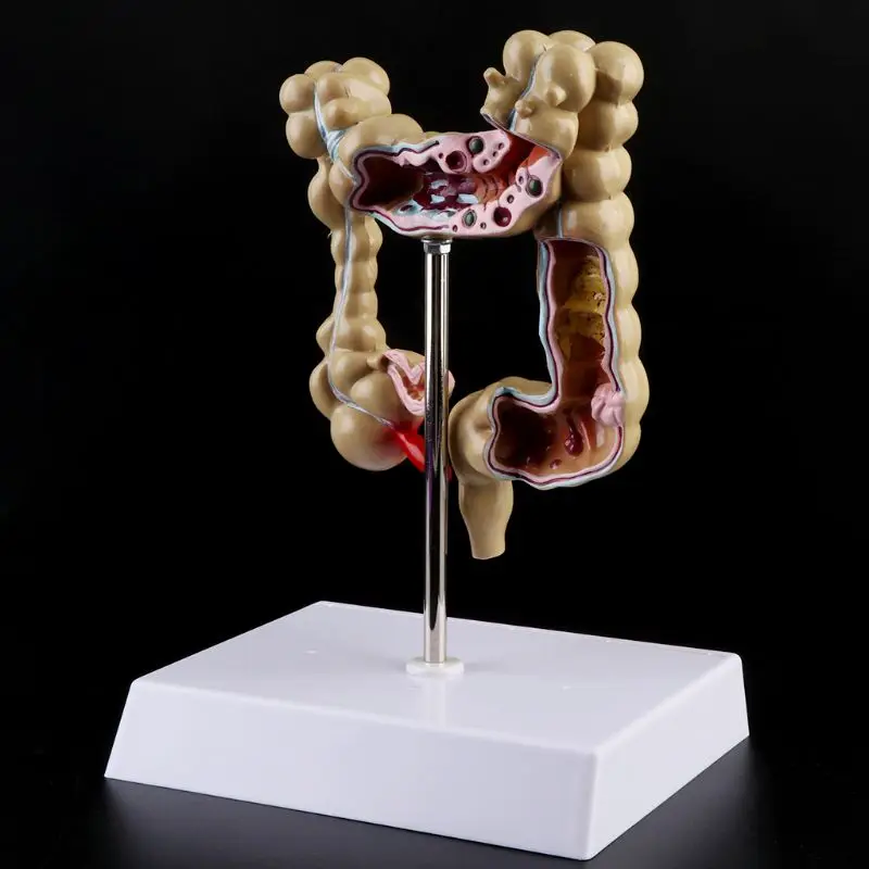 Human Colorectal Lesion Model Pathological Anatomy Colon Diseases Intestine Medical Teaching Learning Tool