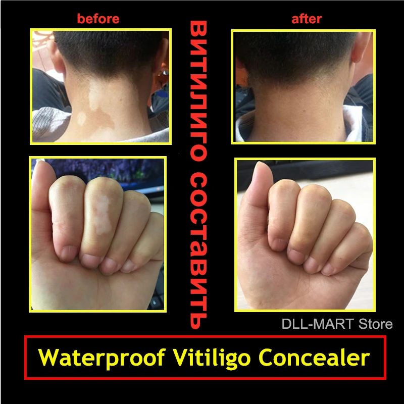 Vitiligo Skin Camouflage Cover Waterproof Cosmetic Makeup Liquid Long-lasting Coverage Masking on Face, Hands and Body