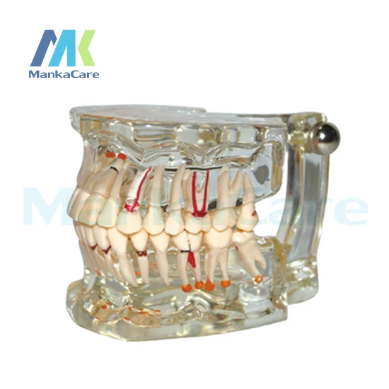 

Manka Care - Pathology Model with half implant Oral Model Teeth Tooth Model