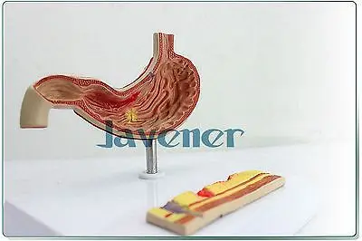 

Human Anatomical Gastric Ulcer Medical Model Learning Resources Digestive