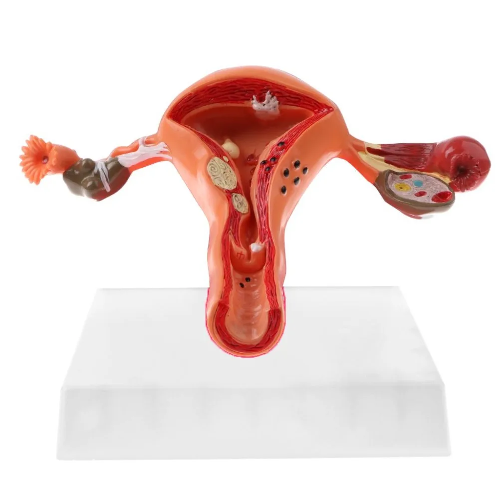 

Medical props model Pathological Uterus Ovary Anatomical Model Anatomy Cross Section Medical teaching supplies Study Tool