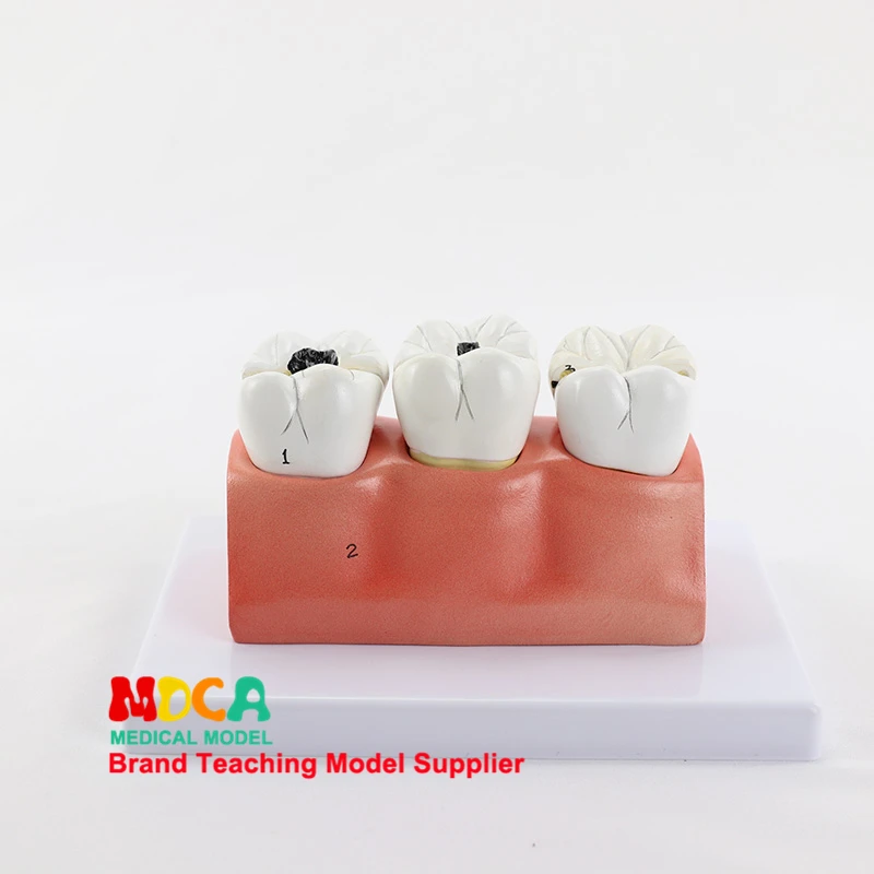 Dental Caries Decomposition Model Dentistry Oral Dentistry Display Medical Teaching Model MYC008