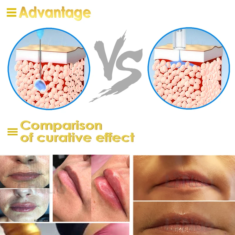 Cabeça de ampola de 0.3ml 0.5ml para caneta hialuron, ponta estéril descartável, pistola de ácido hialurônico, adaptador atomizador, anti-rugas, levantamento labial