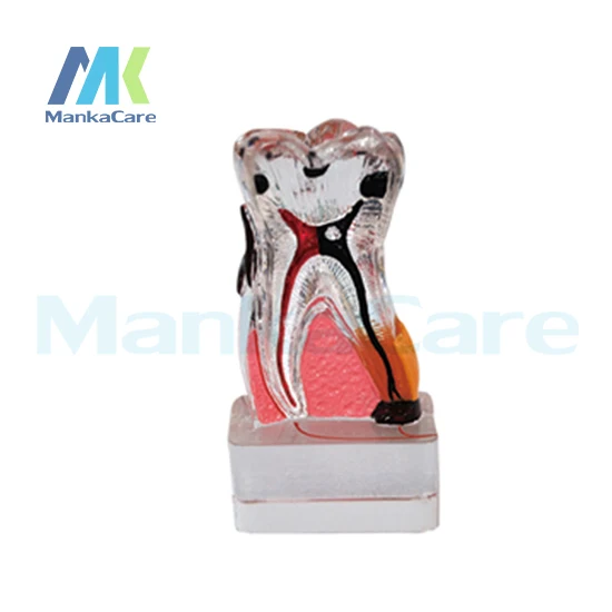 

Manka Care - 4Times periodontal disease/Made of imported resin Oral Model Teeth Tooth Model