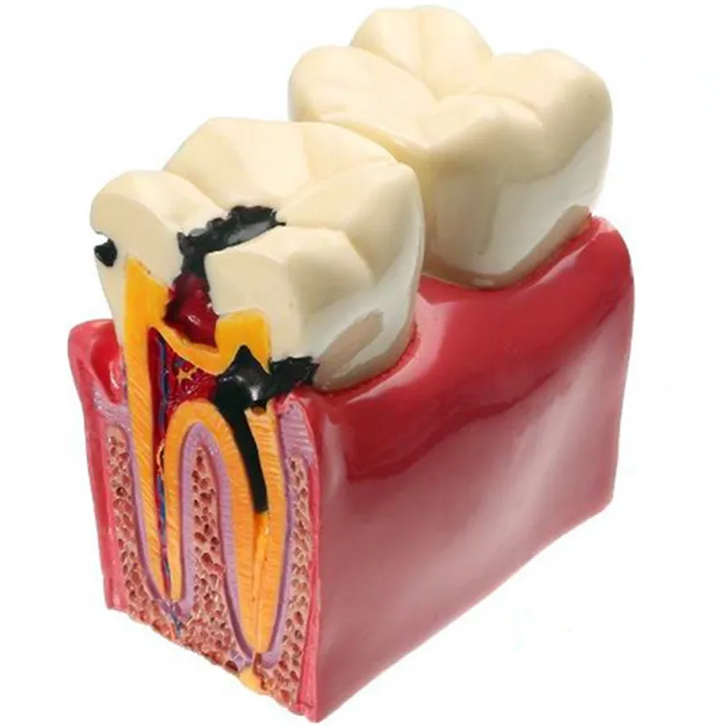 1 pc Dental Materials Lab Teeth Model 6 Times Caries Comparation Study Models For Dentist Studying and Researching