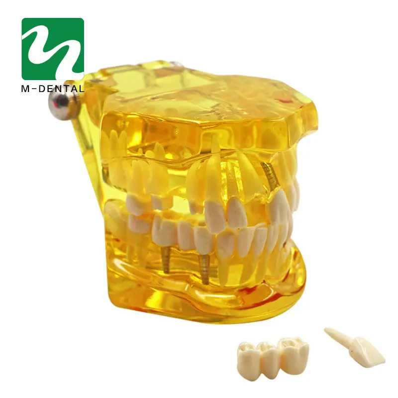 

1PC Yellow Dental Implant Disease Teeth Model with Restoration Bridge Tooth Dentist for Teaching Adult Pathological Teeth Model