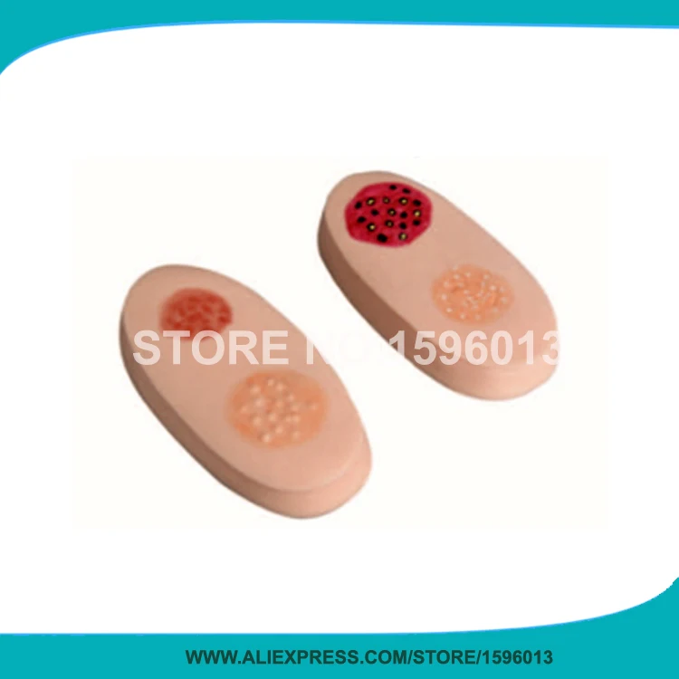 

Vivid Variola Lesion Modules, Smallpox Simulator Skin Model,Variola Pathological Changes Nursing Model