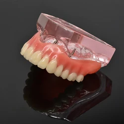 Dental Overdenture Teeth Model Removable Interior Mandibular Lower Teeth Model Mandibular with Implant for Tooth Teaching Study