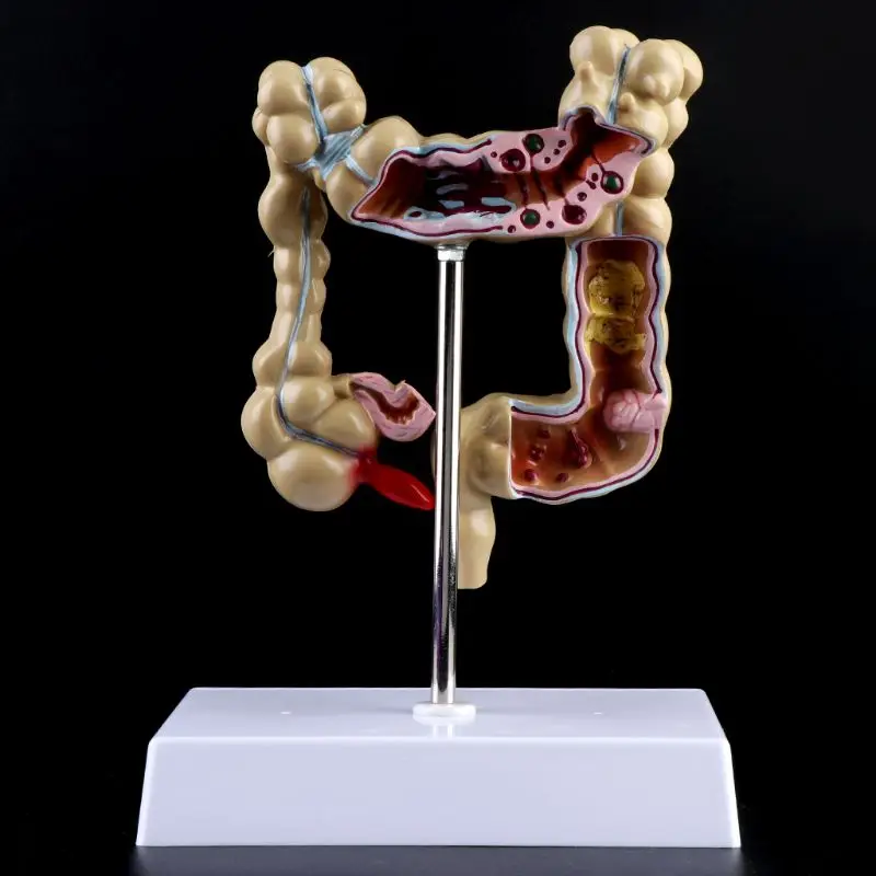 Human Colorectal Lesion Model Pathological Anatomy Colon Diseases Intestine Medical Teaching Learning Tool