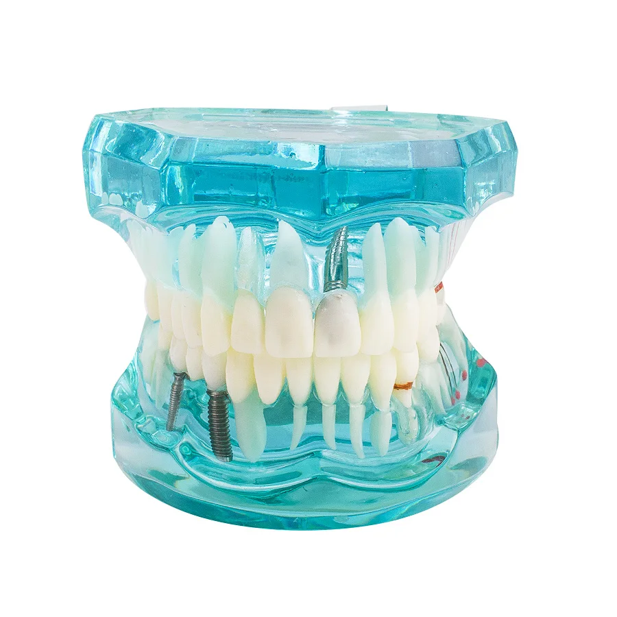 

light blue Promotion Dental Study Tooth Transparent Adult Pathological Teeth Model Dental Lab Equipment Dentist Teaching