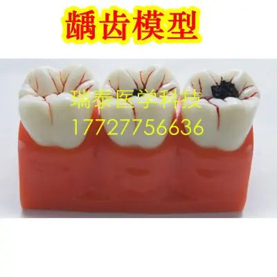 

human model Tooth model detachable medical Dental caries Tooth decay free shipping