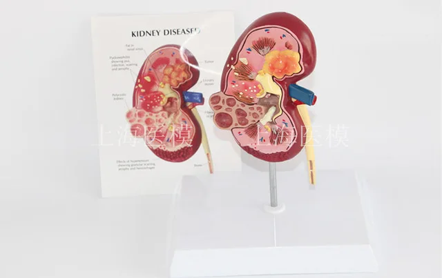 

Kidney disease model urology kidney nephron renal glomerulus kidney anatomical model free shipping