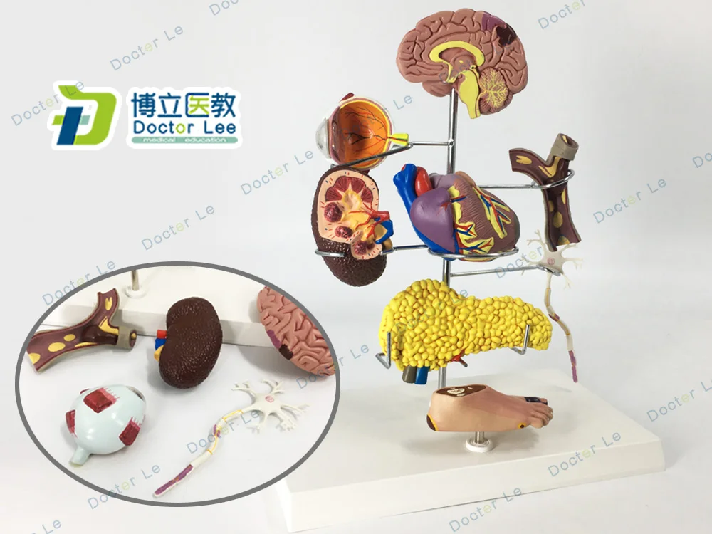 Human medicine diabetes model Complications, brain, pancreatic, neuron, foot surgery