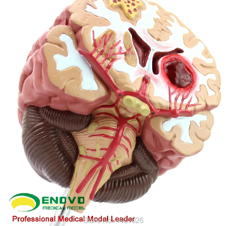 ENOVO Medical human. brain disease model brain model neurosurgery cerebral apoplexy cerebral hemorrhage