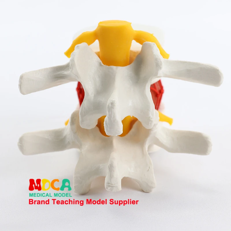 Human Lumbar Disc Herniation Demonstration Spinal Column Anatomical Model Medical Learn Aid Anatomy Teaching Supplies