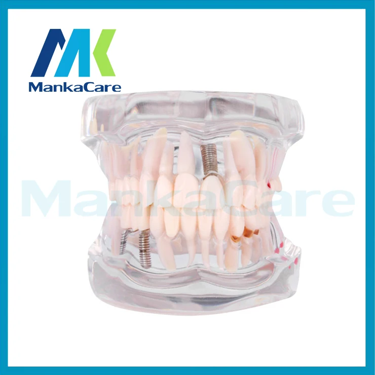 

Manka Care - Removable Dental Implant Disease Teeth Model with Restoration Bridge Tooth Dentist for Medical Science Teaching