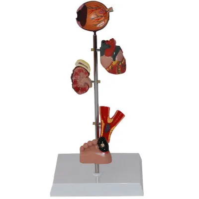 diabetes target organ foot heart kidney model free shipping