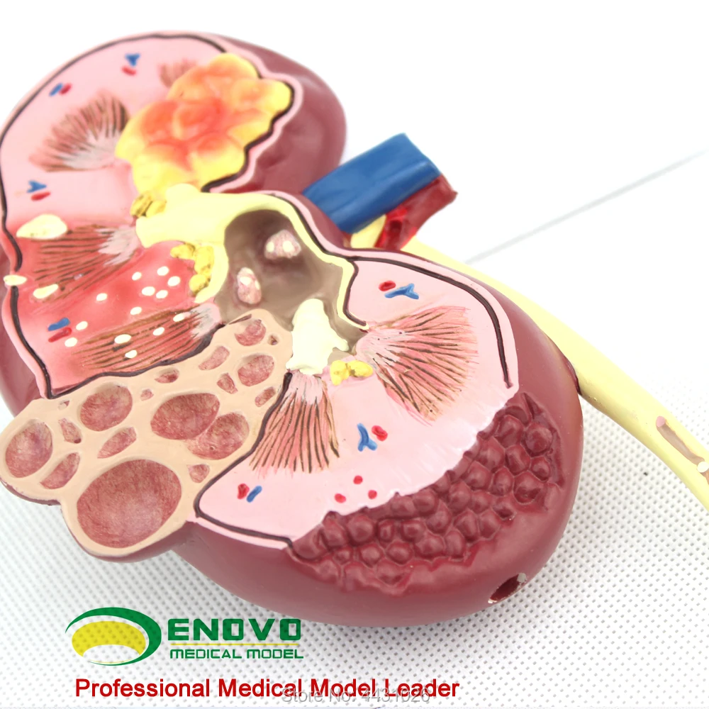 

ENOVO The model of nephropathic urology department of the kidney pathology department