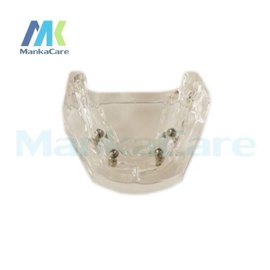 Transparent model. using different implants Oral Model Teeth Tooth Model