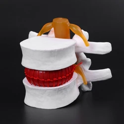 Medical props model Human Anatomical Lumbar Disc Herniation Model Medical Learn Aid Anatomy Instrume