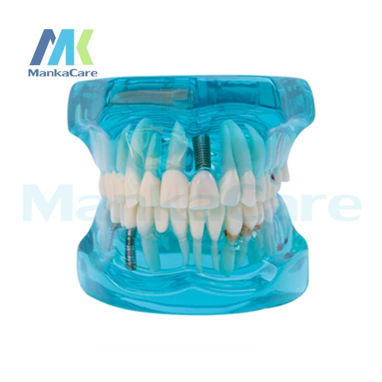 

Manka Care - Restoration with Implant Oral Model Teeth Tooth Model