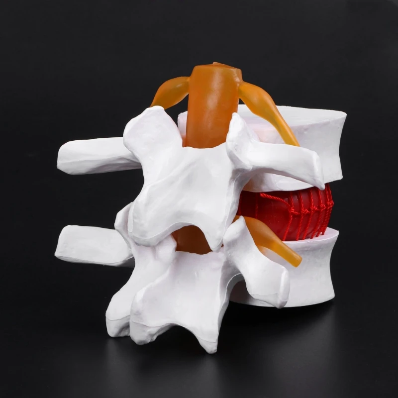 Medical props model Human Anatomical Lumbar Disc Herniation Model Medical Learn Aid Anatomy Instrume