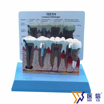 

Teeth model Enlarged version Oral pathology model of dental dental disease implant restoration model