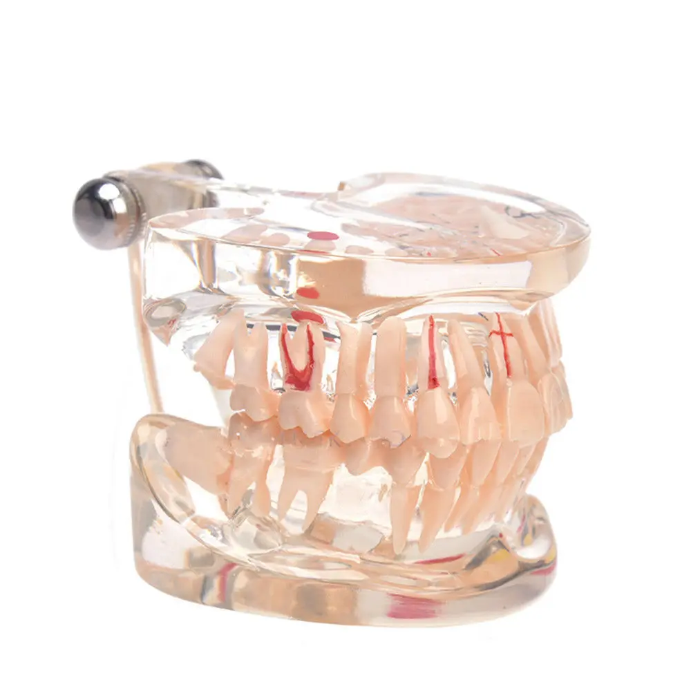 Dental Pathology Model Adult Full Teeth For Doctor-patient Communicate Teach