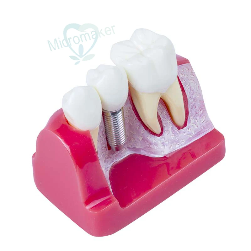 1pc Dental Demonstration Teeth Model Implant Analysis Crown Bridge Teeth Model New