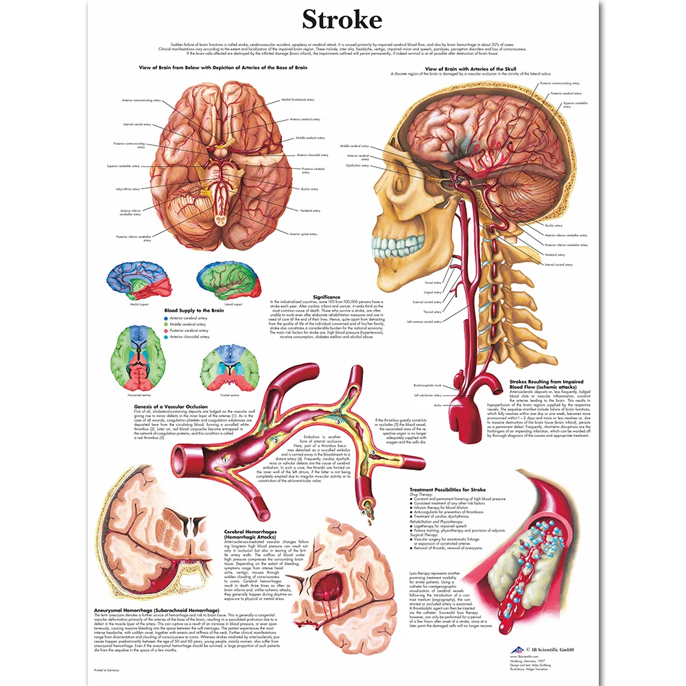 Anatomy of Brain in Stroke Anatomical Chart Neurological Posters Pathology Canvas Wall Pictures for Medical Education Home Decor