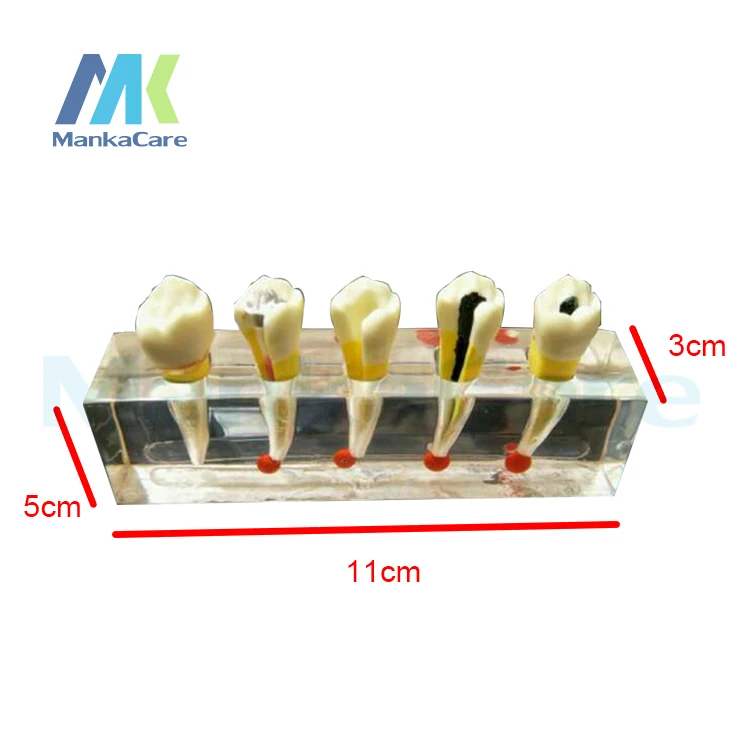 Dental Pulp Disease Clinical Model/5 treatment stages Root Canal Anatomy, Dental Pulp Disease Clinical Model, Educational