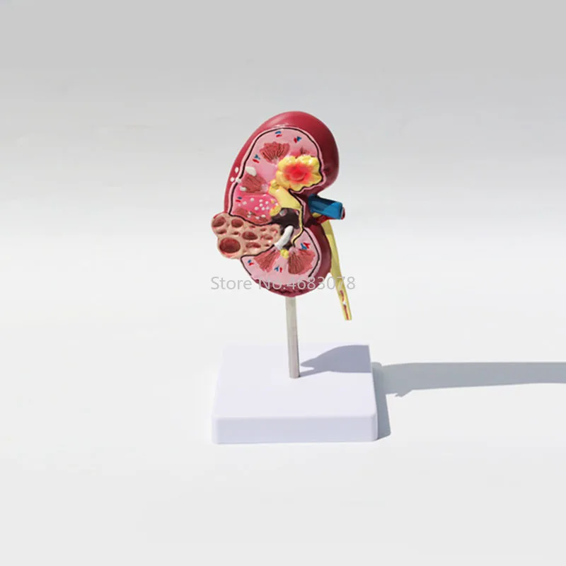 Human Body Organ Medical Kidney Anatomical Model Diseased Kidney  Model Human Anatomy Teaching Supplies