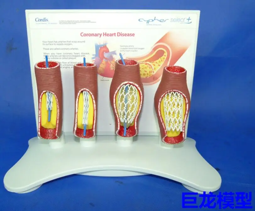 blood  vessel blockage model Anatomical model of human cardiac and cerebrovascular occlusion teaching