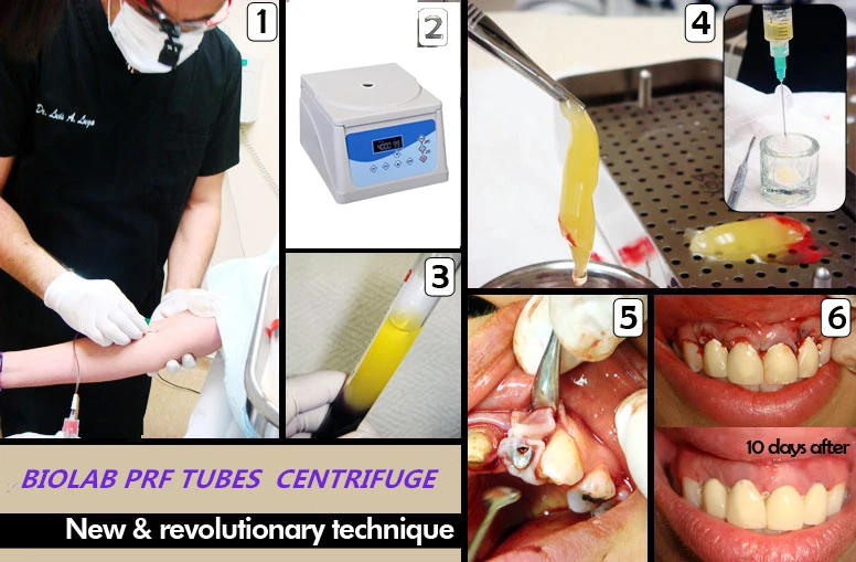 PRF Platelet Rich Fibrin Centrifuge, Blood PRP For Detistry, Maxillofacial, Orthopedics, Plastic Surgery