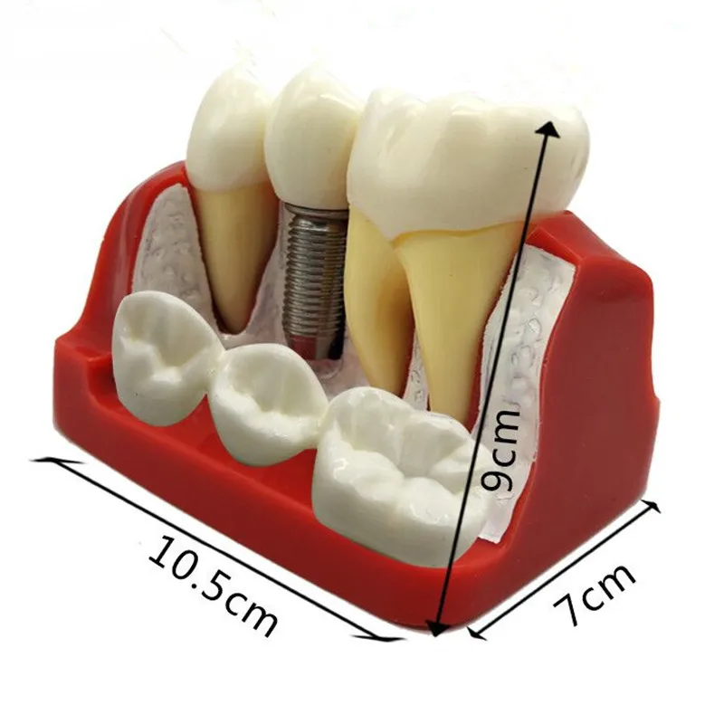 

4 Times Dental Implant Disease Analysis with Restoration Crown Bridge Demonstration Dental Teeth Model Teaching study M