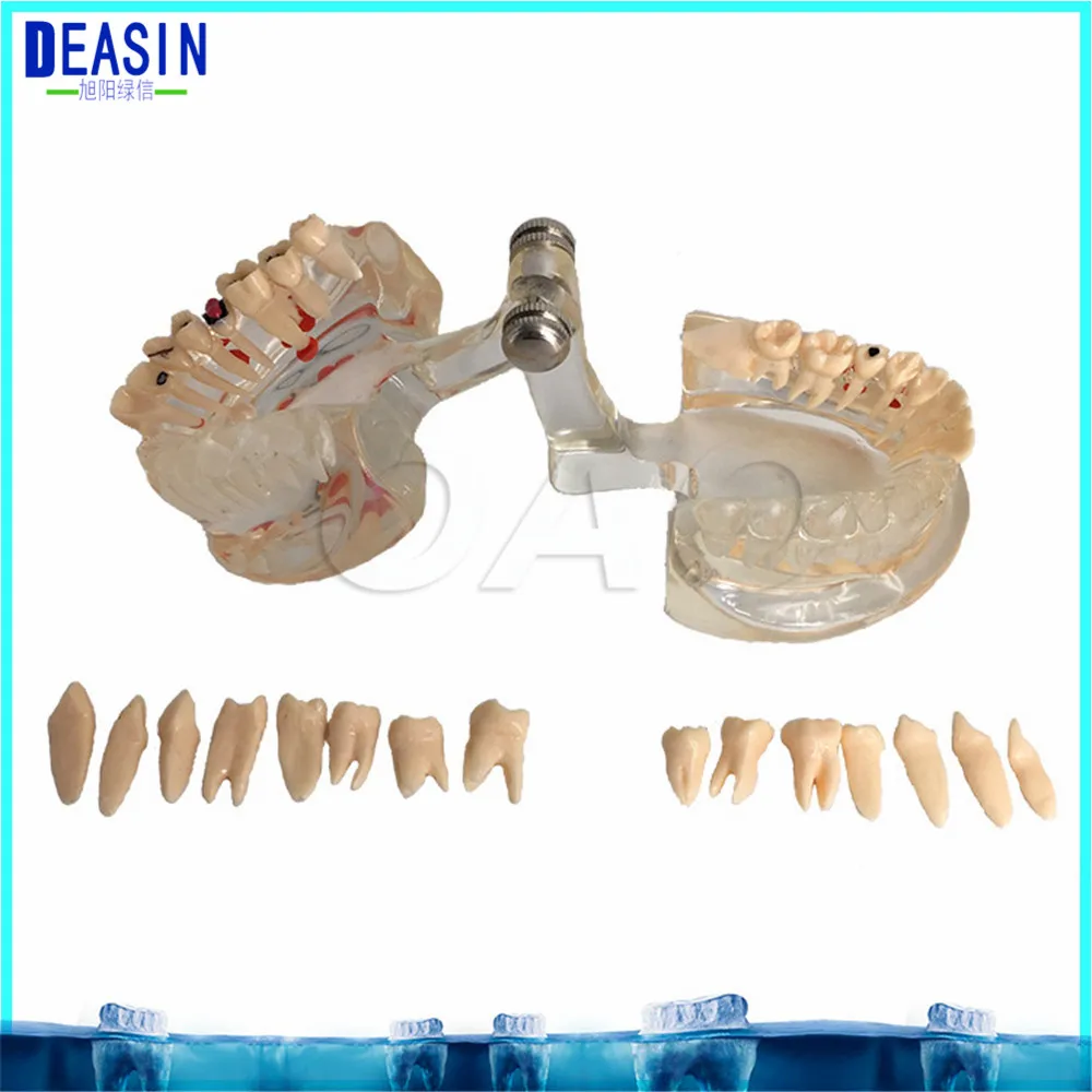 

Dental Implant Teeth Half side can be removeble model Pathological Model Teaching& Restoration Bridge Tooth