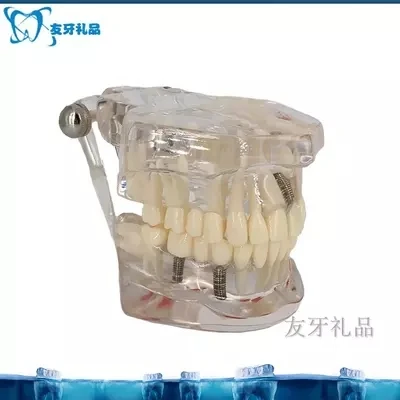 Adult teeth model transparent pathological planting model free shopping