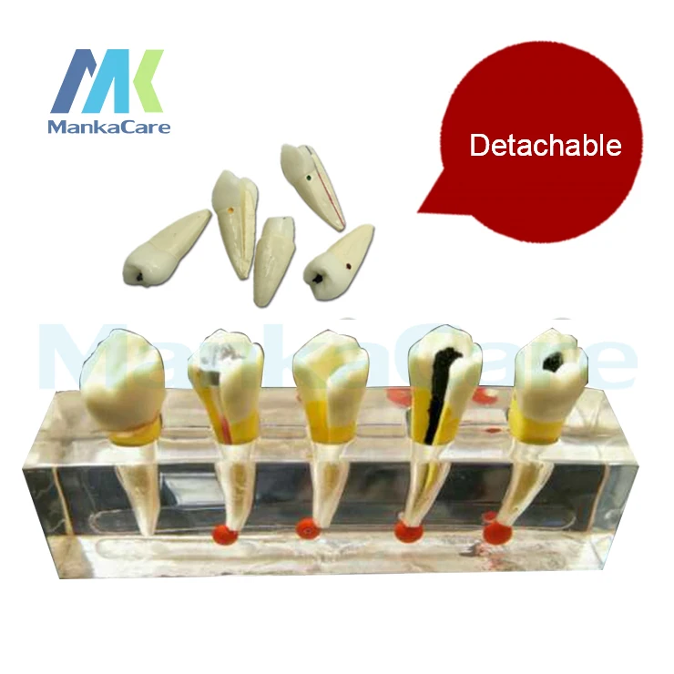 

Dental Pulp Disease Clinical Model/5 treatment stages Root Canal Anatomy, Dental Pulp Disease Clinical Model, Educational