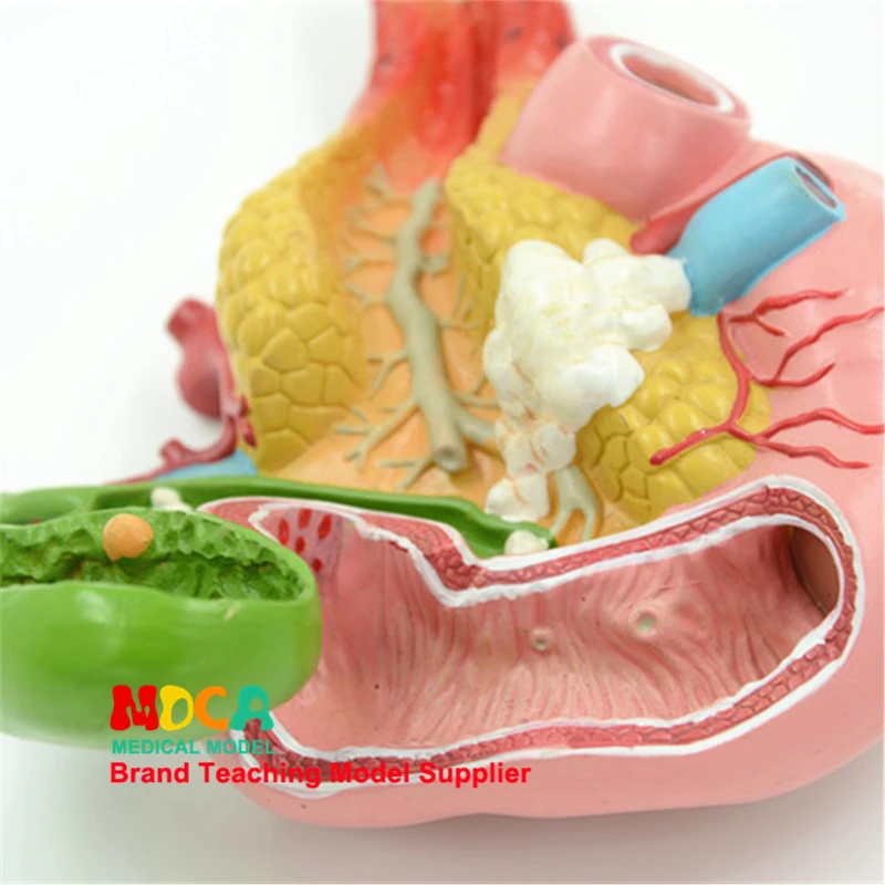 Diseased Pancreas Spleen Hepatobiliary Duodenum Model Human Pathological Anatomy Teaching Model