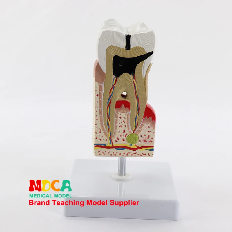 Dental Anatomy Model, Tooth Enlargement, Tooth Decay, Gingival Display, Medical Medical Teaching Tool